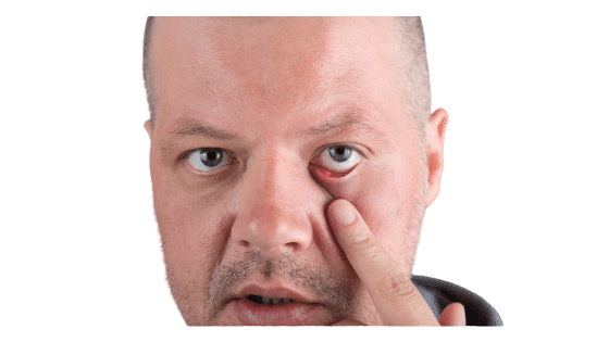 Cómo Curar Orzuelos en los Ojos