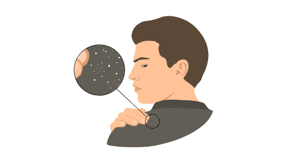 Cómo Eliminar la Caspa: Rápido y de Forma Definitiva