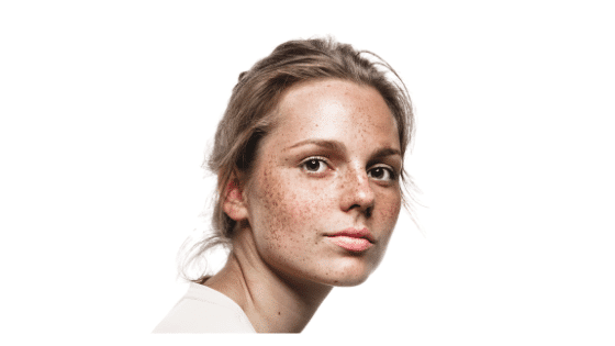 Cómo Eliminar las Pecas ¿Es posible?