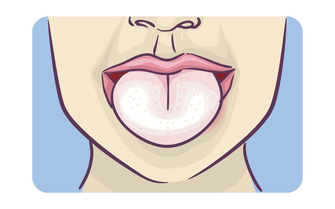 Como Quitar lo Blanco de la Lengua