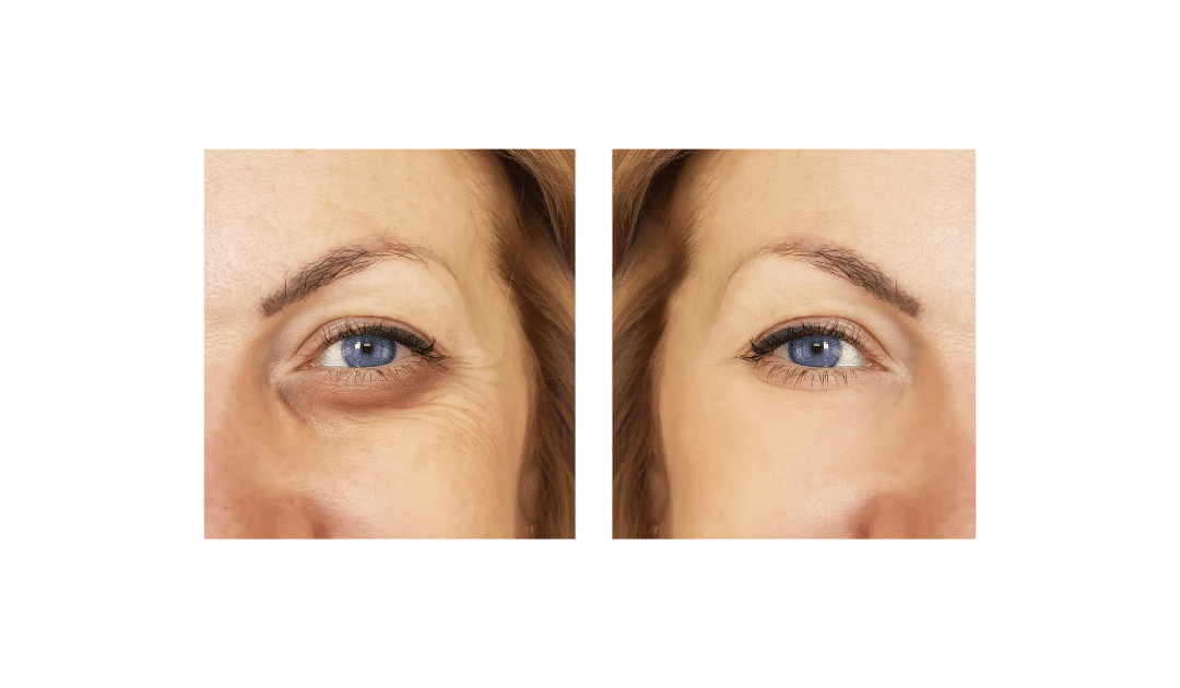 Como Eliminar Las Ojeras De Nacimiento