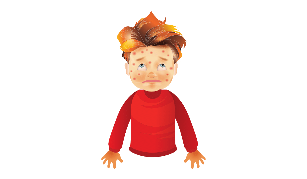 Cómo saber si un Niño o un Adulto tienen Varicela